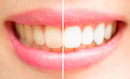 Bleaching für weiße Zähne - Zahnarztzentrum Hiltrup