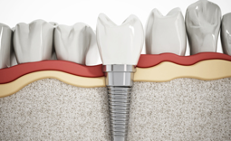 Implantat-Behandlungen im Zahnärzte-Zentrum Hiltrup