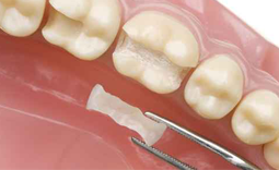 Inlays für beschädigte Zähne - Zahnzentrum Hiltrup